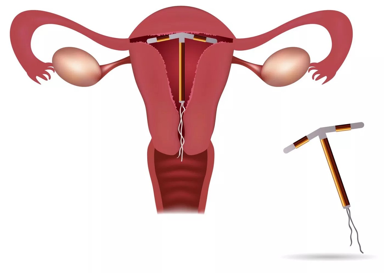 Vòng tránh thai là dụng cụ tránh thai được đặt vào tử cung của phụ nữ để mang lại hiệu quả ngừa thai