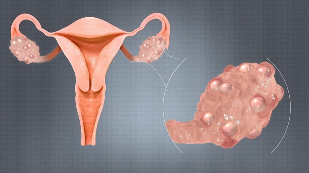 U nang buồng trứng là những khối u hình thành từ tế bào bất thường phát triển trong buồng trứng