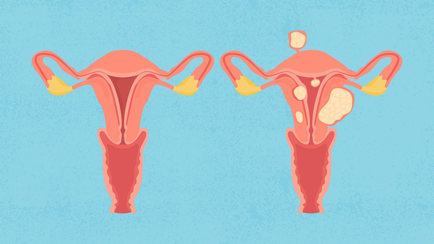 U xơ tử cung là tình trạng trong tử cung của người phụ nữ xuất hiện các khối u bất thường