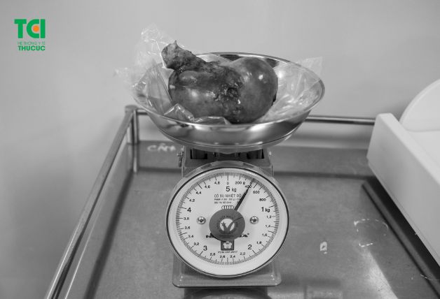 U xơ tử cung có thể nặng từ 0,5 - hơn 1kg