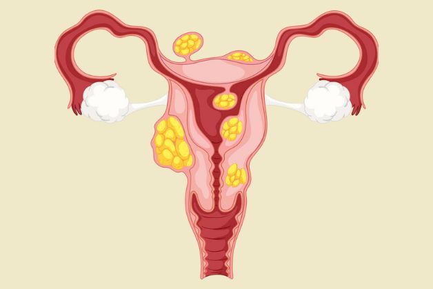 U xơ tử cung có thể xuất hiện ở bất kỳ một thời điểm nào đó trong cuộc đời phụ nữ