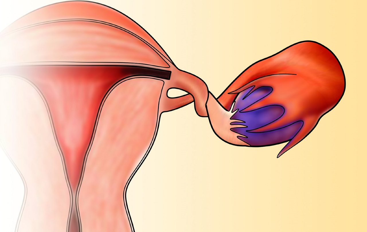 Xoắn buồng trứng là một tình trạng y tế liên quan đến buồng trứng của phụ nữ
